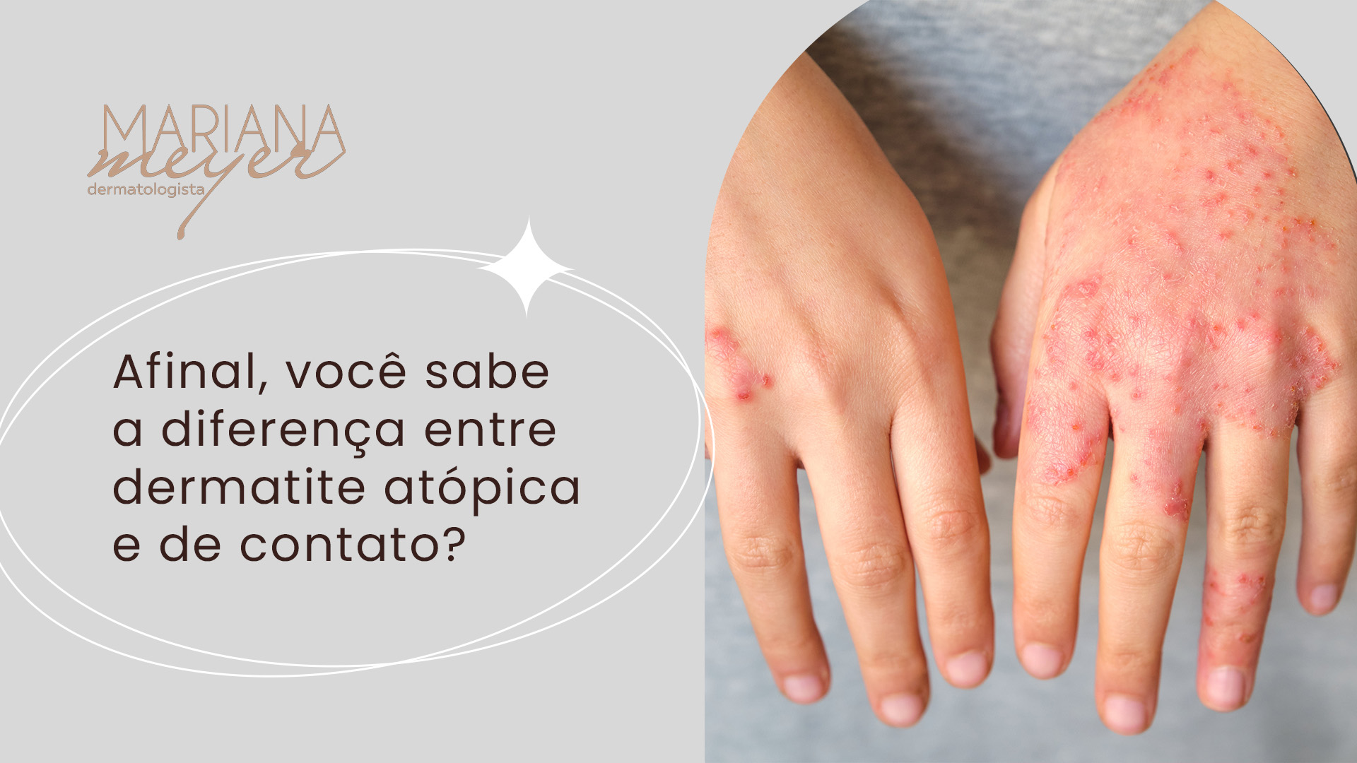 o que causa dermatite atópica