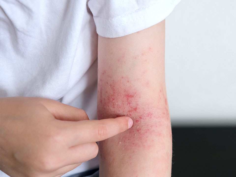 tratamento dermatite atópica crianças