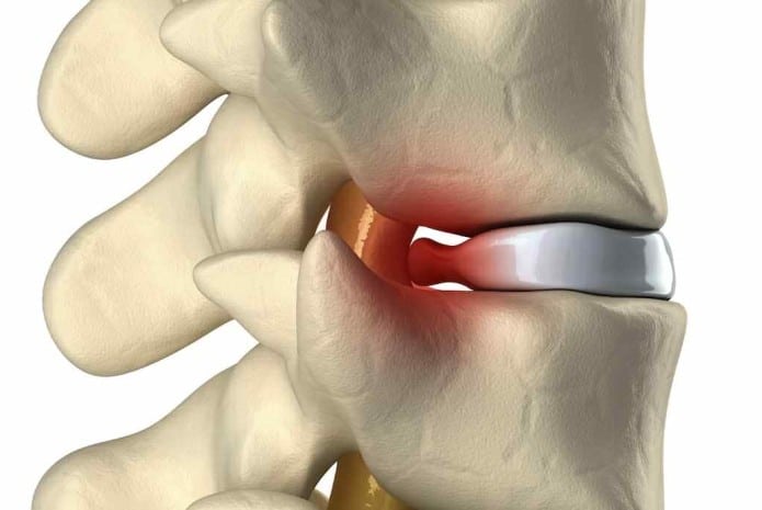 o que é discopatia degenerativa