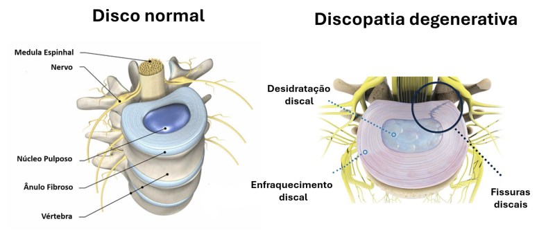melhores exercícios para discopatia degenerativa