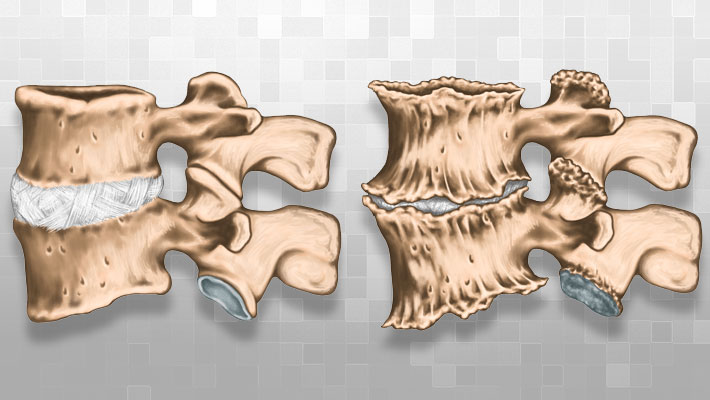 erros comuns no tratamento de discopatia degenerativa