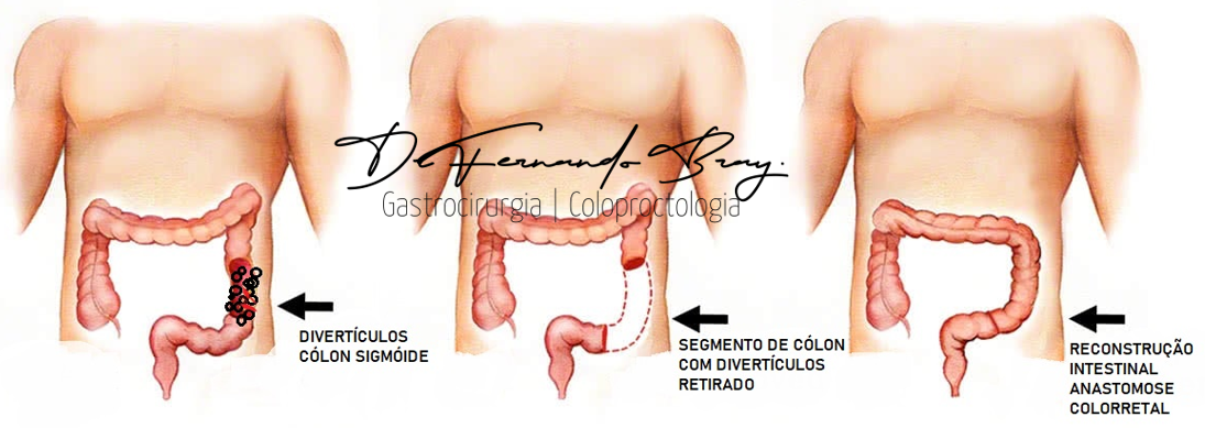 o que causa diverticulose no intestino