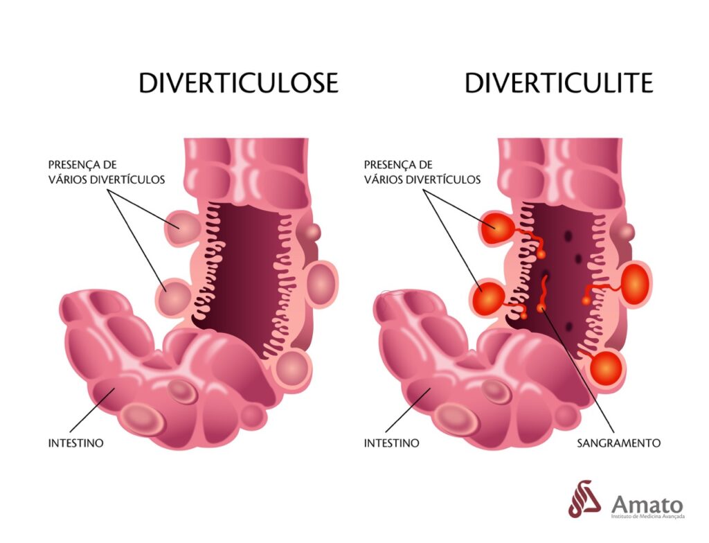 erros comuns ao lidar com diverticulose
