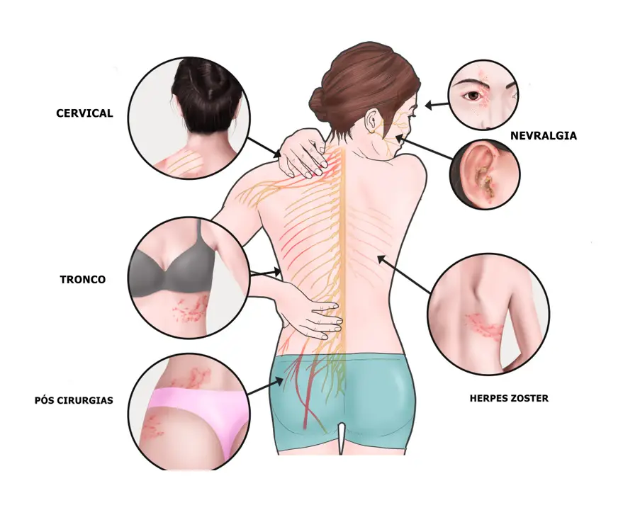 tipos de dor neuropática e seus sintomas
