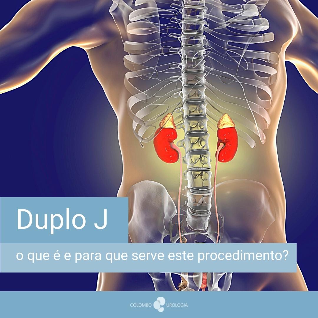 tipos de cateter duplo j para cada condição