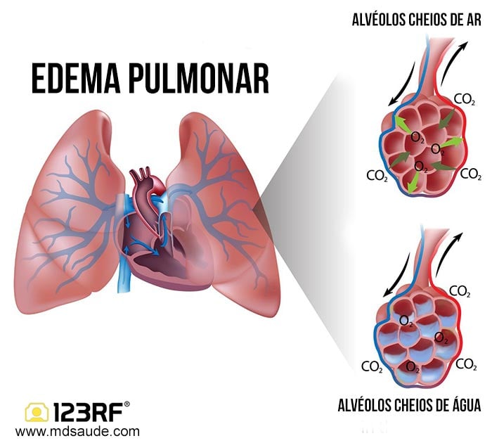 edema pulmonar cardiogênico