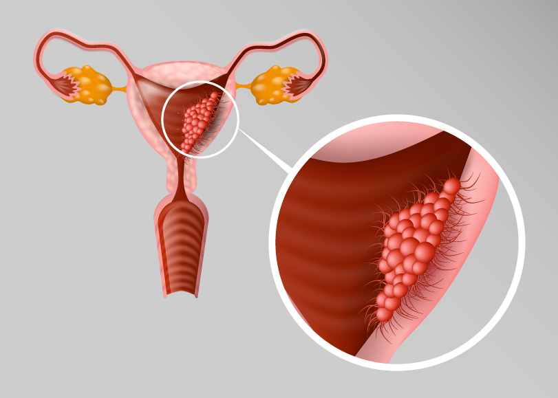 erros comuns ao diagnosticar endometriose