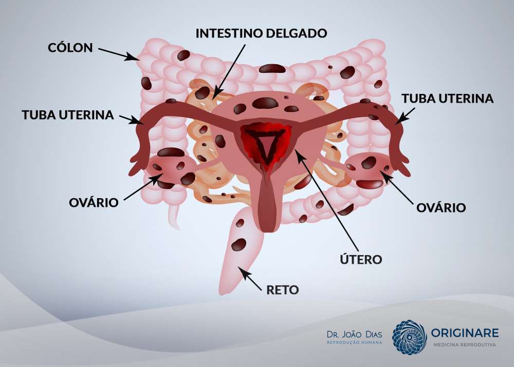 o que é endometriose profunda