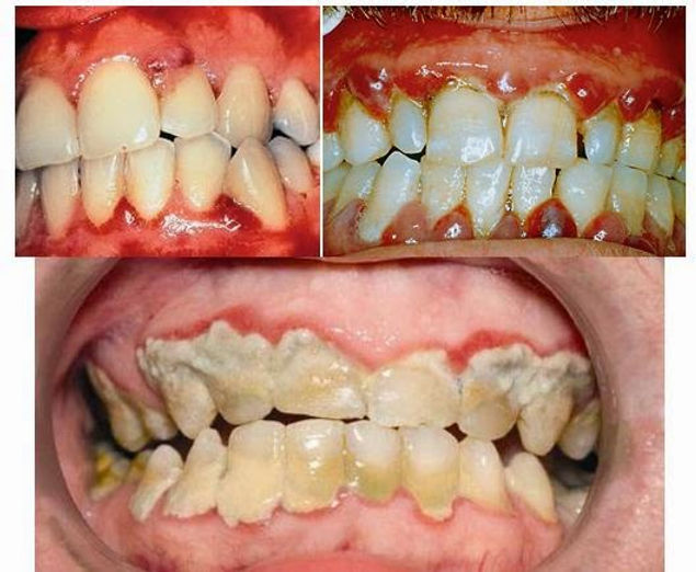 o que causa escorbuto