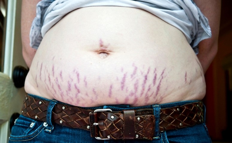 creme para estrias vs laser qual o melhor