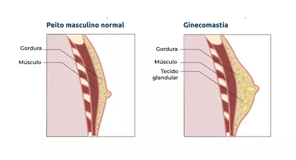 qual a diferença entre ginecomastia e gordura no peito