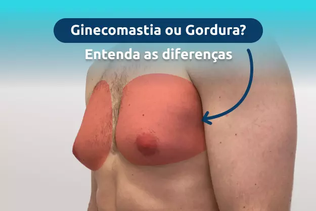 tratamento para ginecomastia