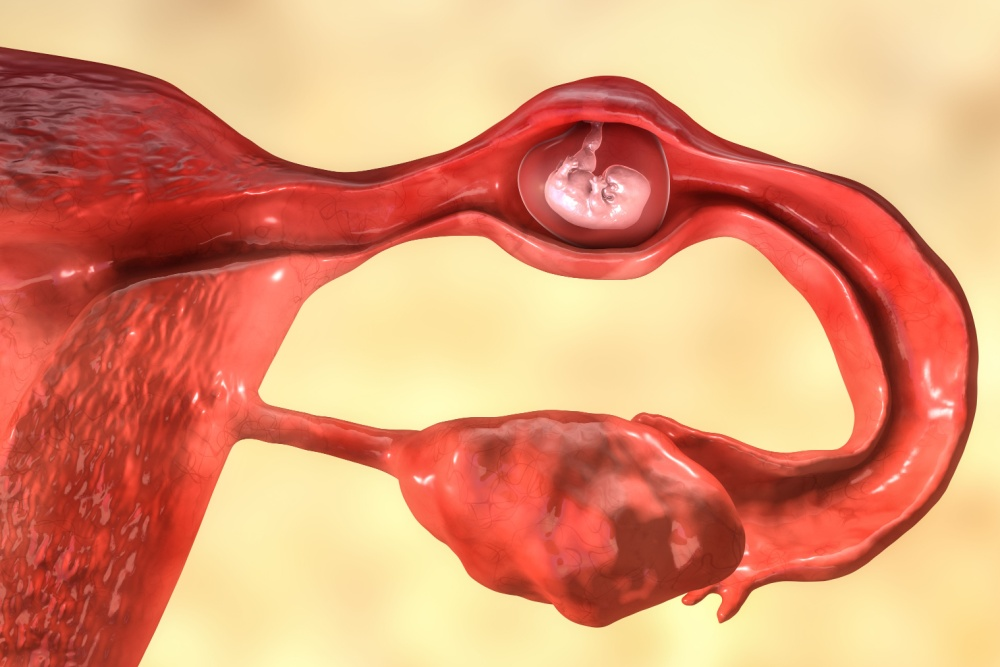 gravidez ectópica tratamento