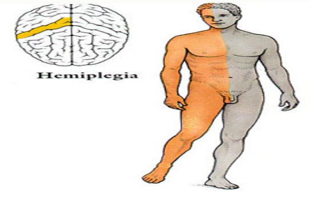 hemiplegia sintomas e tratamento
