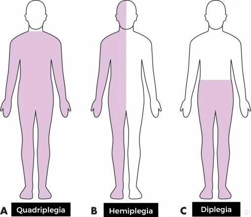 hemiplegia em idosos