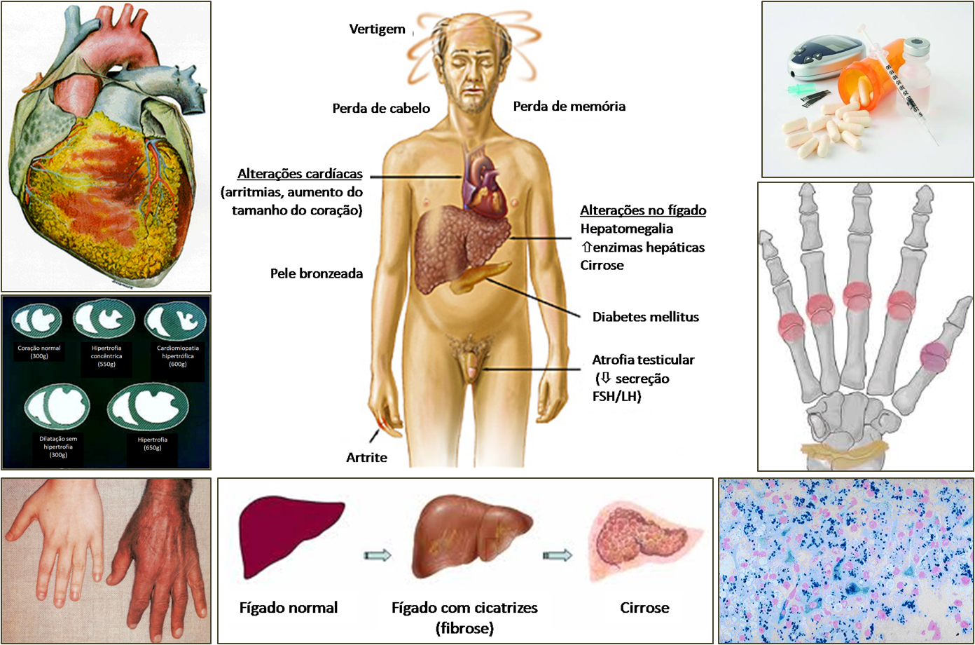 hemocromatose hereditária