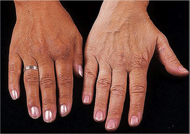 sintomas de hemocromatose