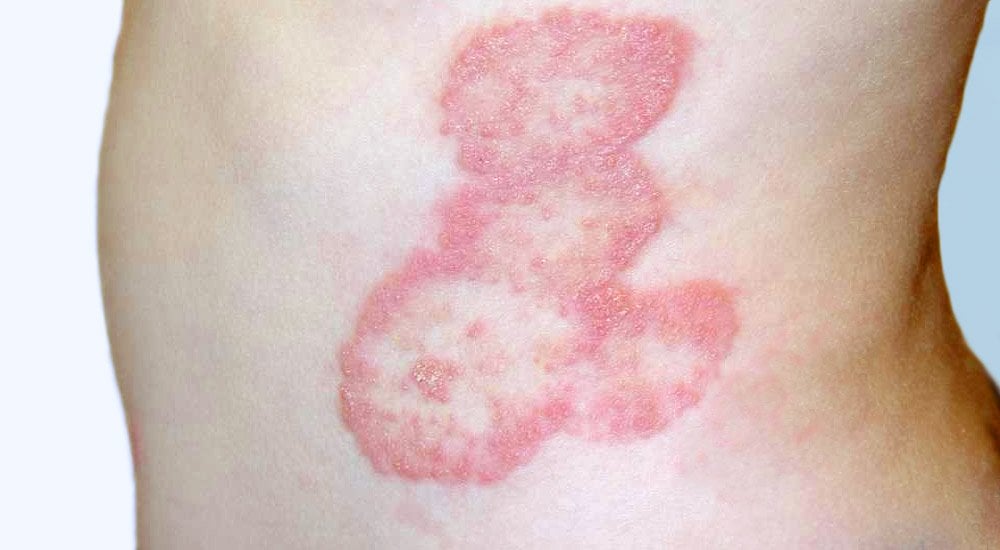 fotos de impinge no corpo humano