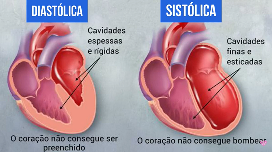 o que é insuficiencia cardiaca