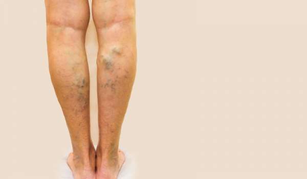 melhores meias para insuficiência venosa