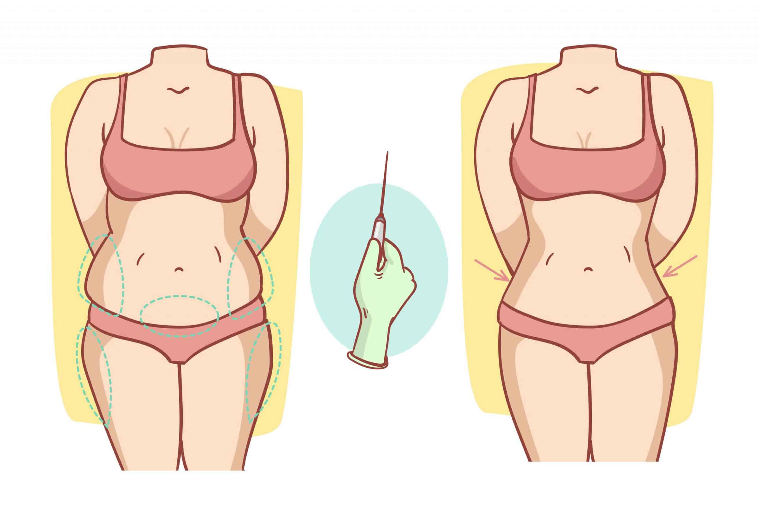 o que é lipoaspiração