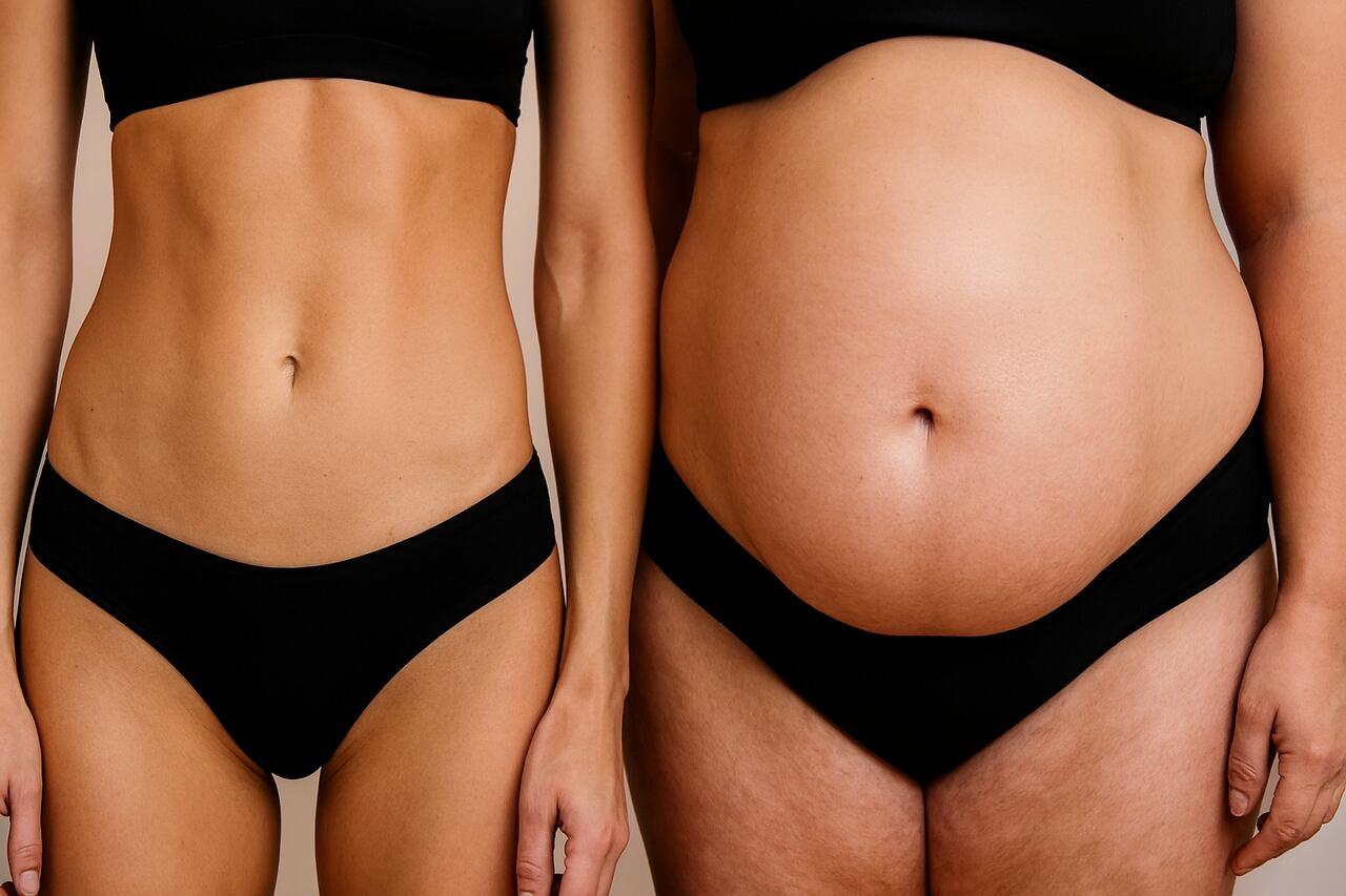 melhores áreas para lipoaspiração