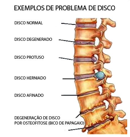 exercícios para dor nas costas