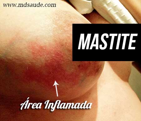 o que causa mastite na amamentação