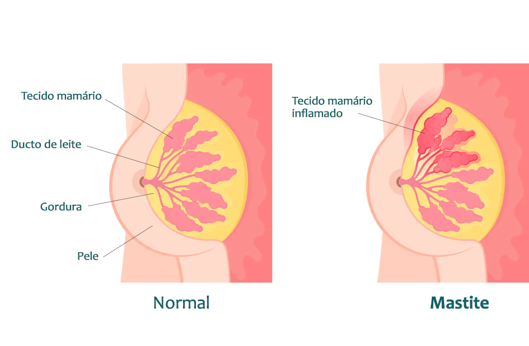 erros comuns no tratamento da mastite