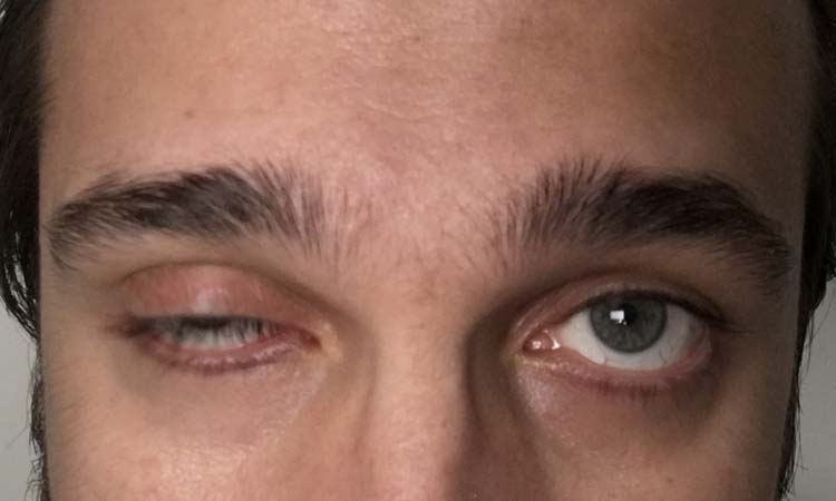 miastenia gravis sintomas