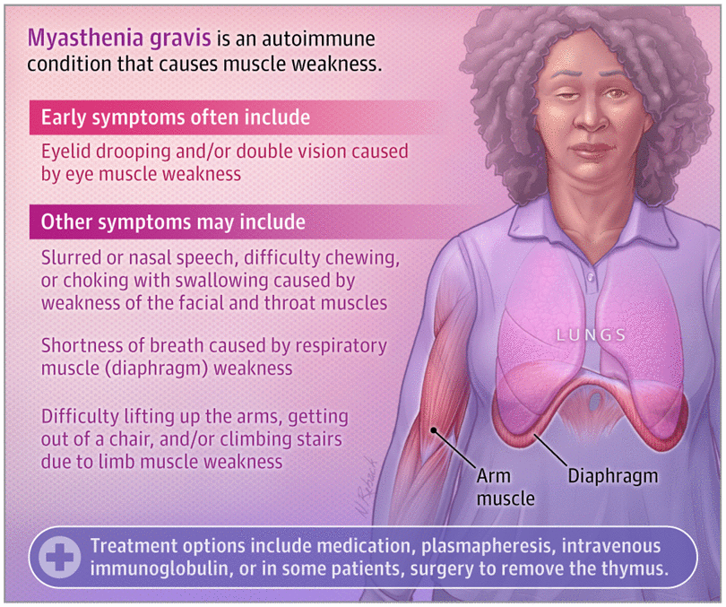 tratamento miastenia gravis