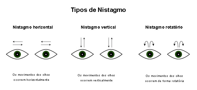 o que é nistagmo