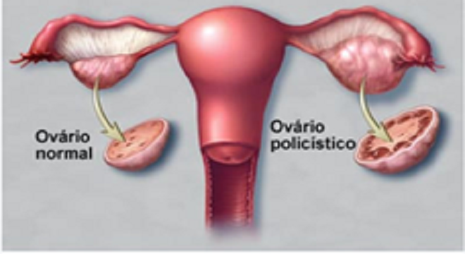 síndrome do ovário policístico