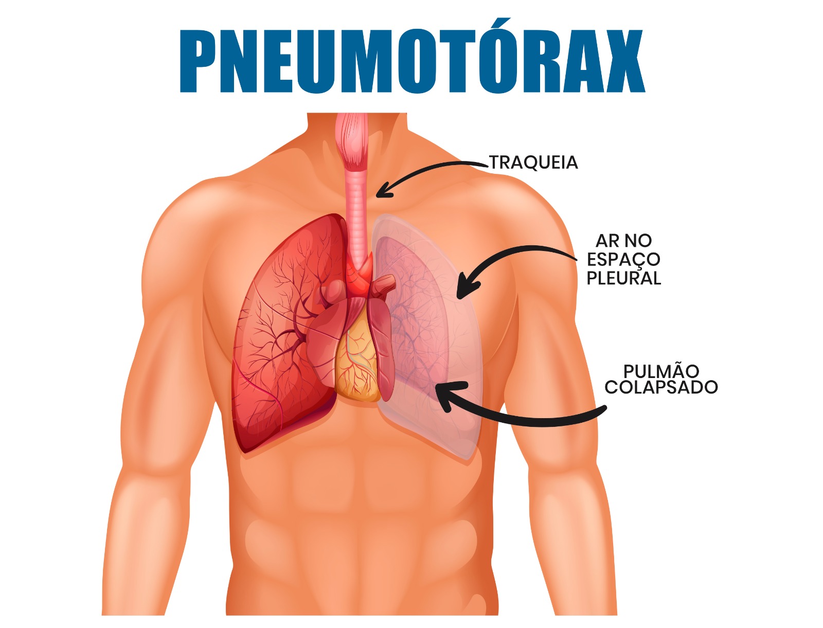 sintomas de pneumotórax em jovens