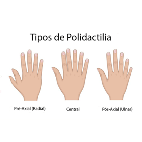 erros comuns ao lidar com polidactilia em bebês