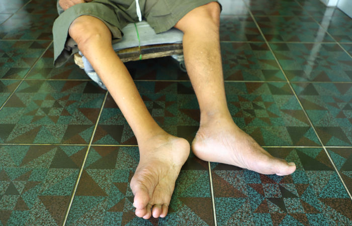 erros comuns na vacinação contra paralisia infantil