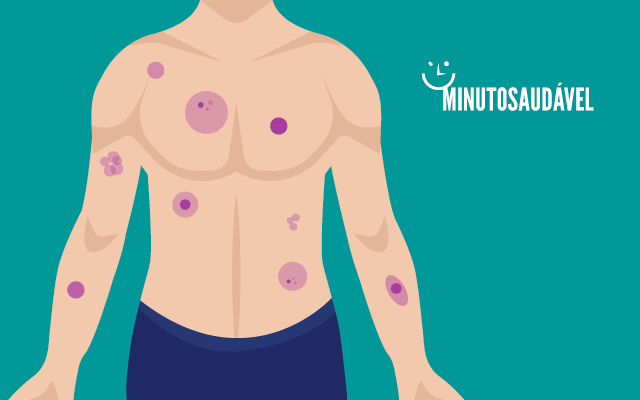 tipos de purpura e suas caracteristicas