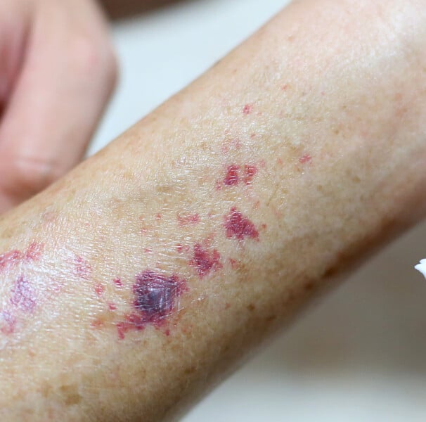 erros comuns no diagnostico de purpura