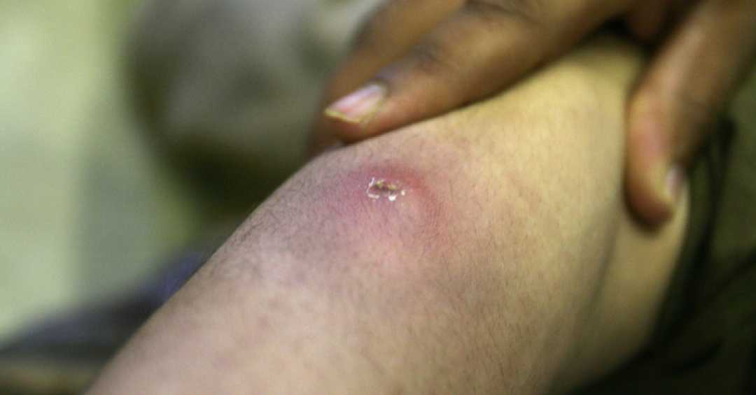 pus na garganta é perigoso