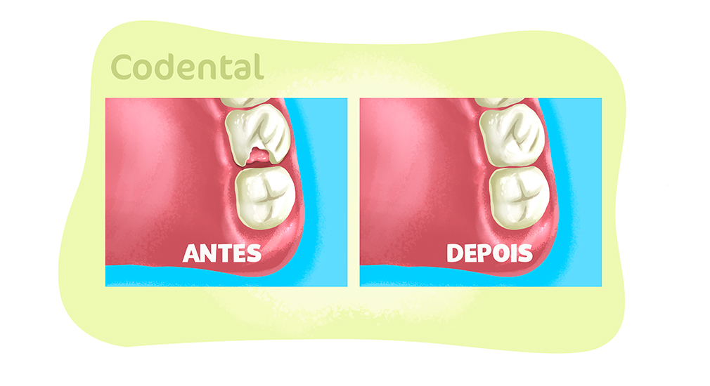 o que é restauração no dente