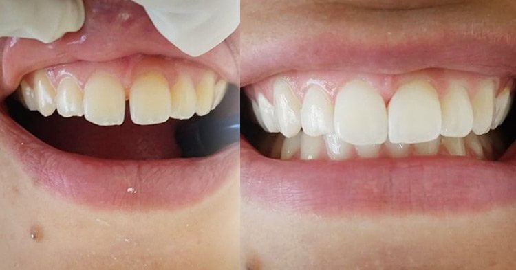 tipos de restauração dental para cada problema