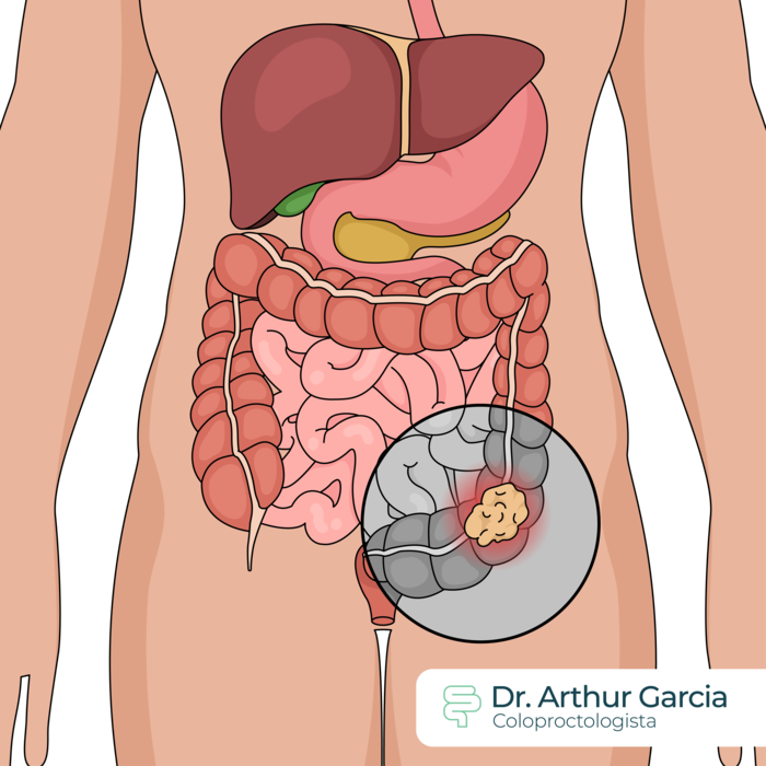 erros ao identificar dor retal