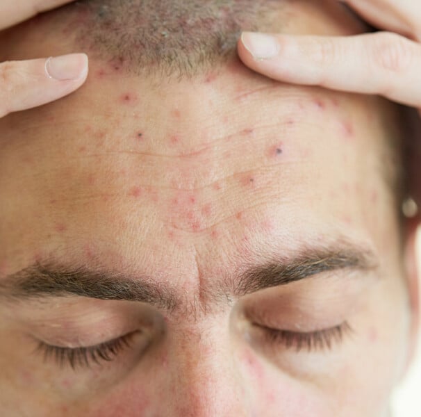 sarna humana sintomas e tratamento