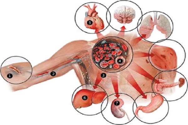 erros comuns no tratamento da sepse