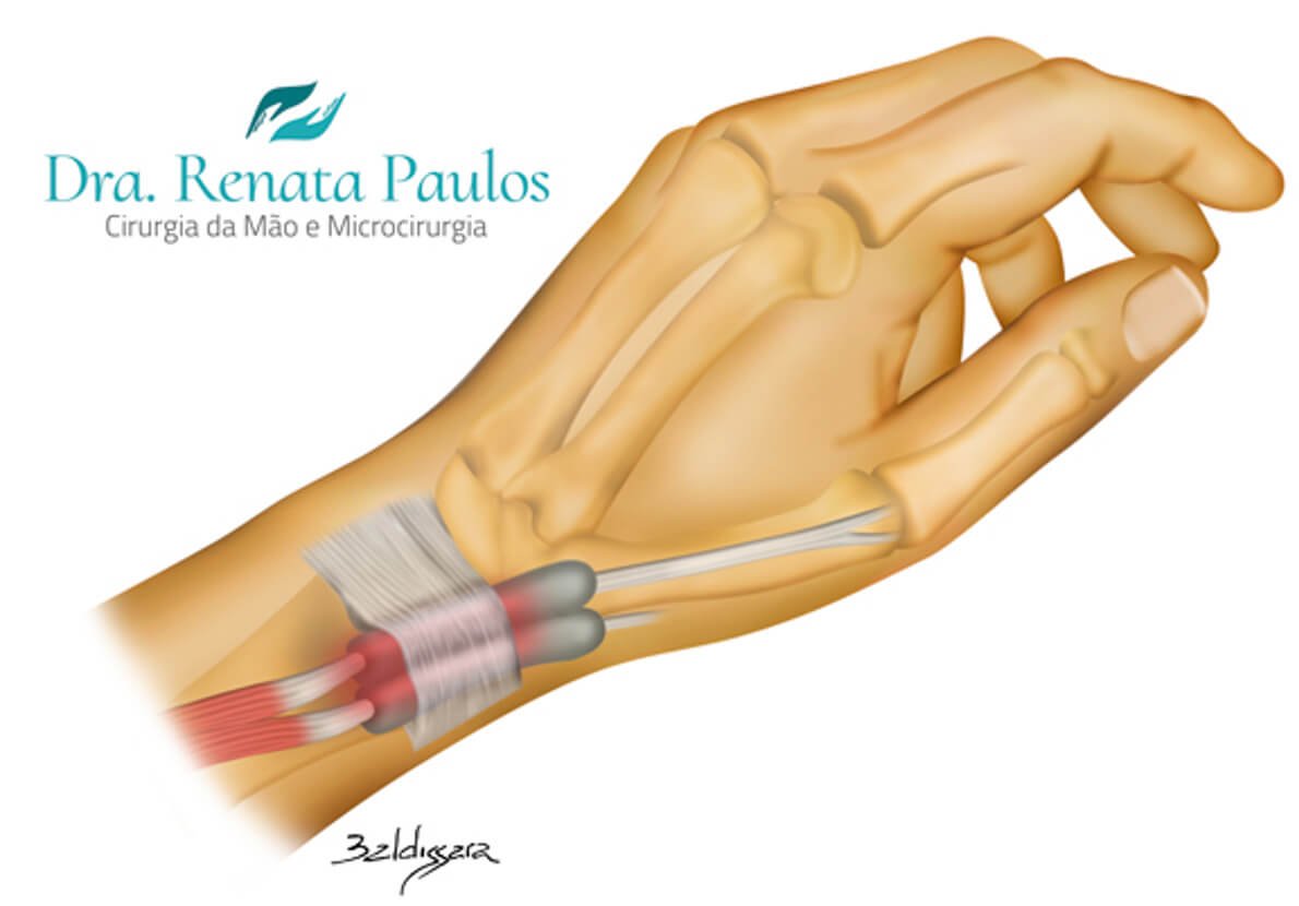 o que é tenossinovite