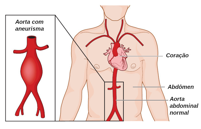 aneurisma da aorta