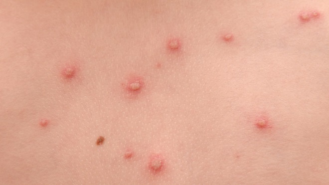 varicela em crianças e adultos