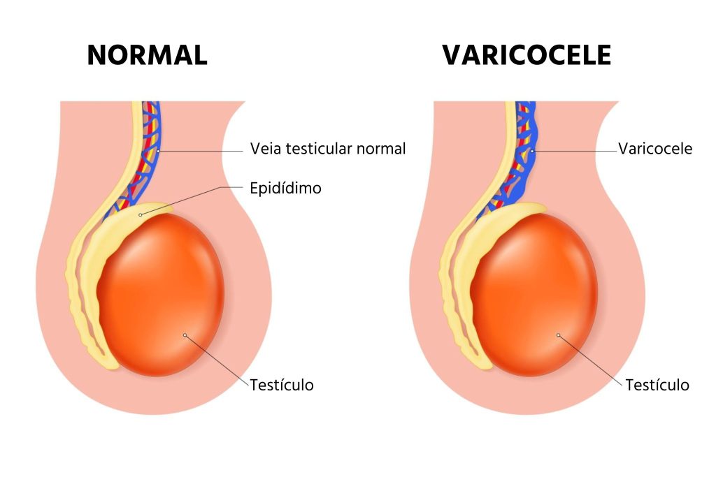 varicocele o que é