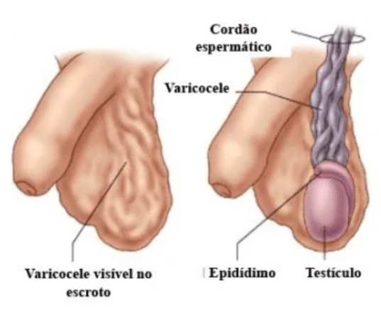 varicocele sintomas