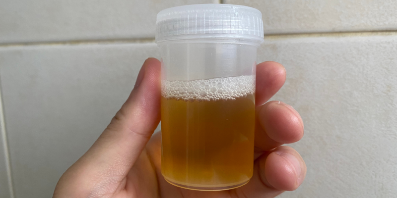 proteinúria e diabetes